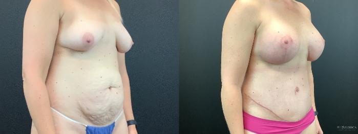 Before & After Mommy Makeover Case 271 Right Oblique View in St. Louis, MO