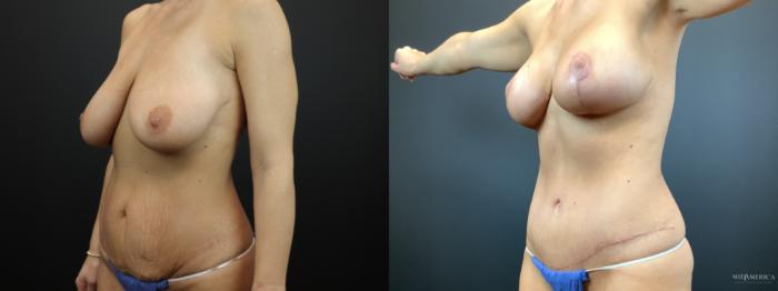 Before & After Mommy Makeover Case 293 Left Oblique View in Glen Carbon, IL