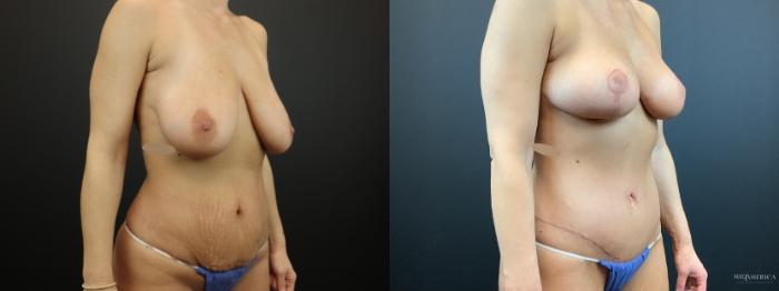 Before & After Mommy Makeover Case 293 Right Oblique View in Glen Carbon, IL