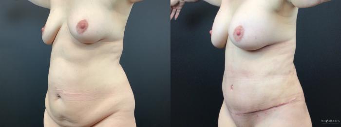 Before & After Mommy Makeover Case 302 Left Oblique View in St. Louis, MO