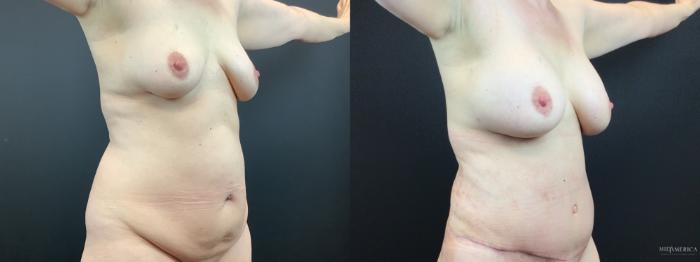Before & After Mommy Makeover Case 302 Right Oblique View in St. Louis, MO