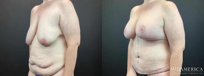 Before & After Mommy Makeover Case 315 Left Oblique View in St. Louis, MO