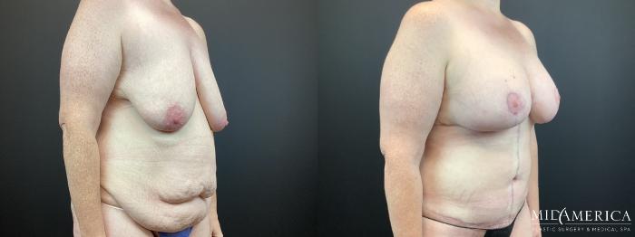 Before & After Mommy Makeover Case 315 Right Oblique View in St. Louis, MO