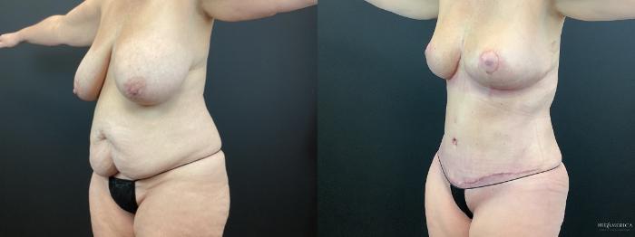 Before & After Mommy Makeover Case 317 Left Oblique View in St. Louis, MO