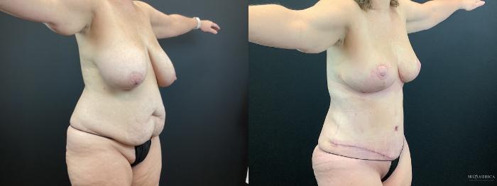 Before & After Mommy Makeover Case 317 Right Oblique View in St. Louis, MO