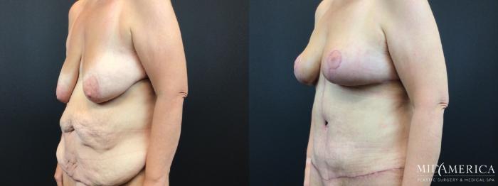 Before & After Mommy Makeover Case 327 Left Oblique View in St. Louis, MO