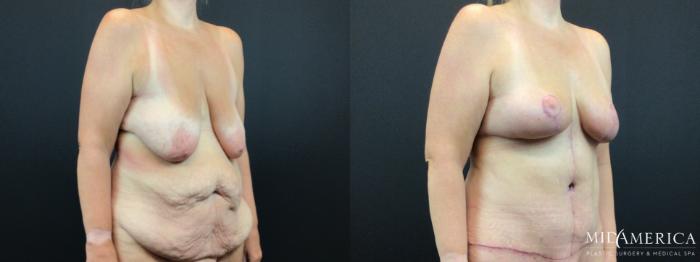 Before & After Mommy Makeover Case 327 Right Oblique View in St. Louis, MO