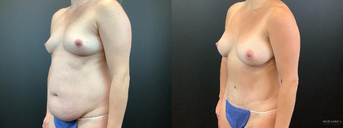 Before & After Mommy Makeover Case 338 Left Oblique View in St. Louis, MO