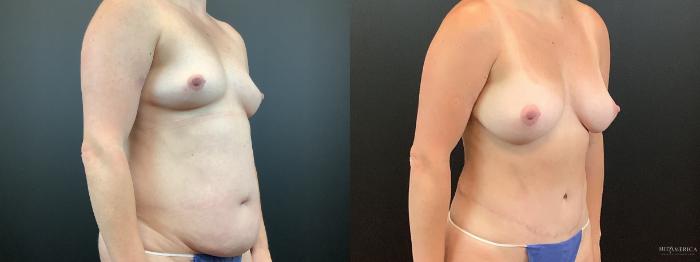 Before & After Mommy Makeover Case 338 Right Oblique View in St. Louis, MO