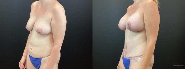 Before & After Mommy Makeover Case 343 Left Oblique View in St. Louis, MO