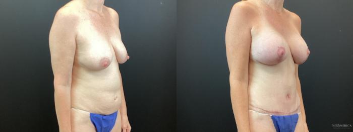 Before & After Mommy Makeover Case 343 Right Oblique View in St. Louis, MO