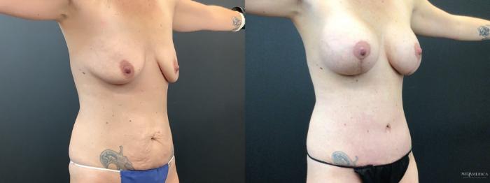 Before & After Mommy Makeover Case 357 Right Oblique View in St. Louis, MO