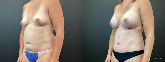 Before & After Mommy Makeover Case 358 Left Oblique View in St. Louis, MO