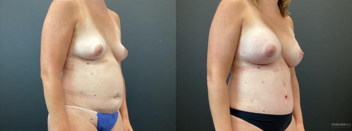 Before & After Mommy Makeover Case 358 Right Oblique View in St. Louis, MO