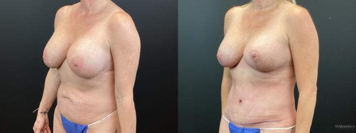 Before & After Mommy Makeover Case 361 Left Oblique View in St. Louis, MO