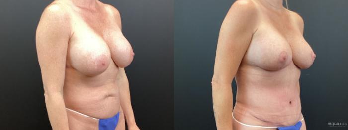 Before & After Mommy Makeover Case 361 Right Oblique View in St. Louis, MO