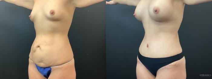 Before & After Mommy Makeover Case 383 Left Oblique View in St. Louis, MO