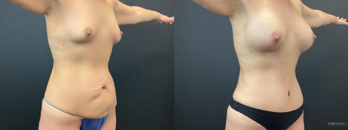 Before & After Mommy Makeover Case 383 Right Oblique View in St. Louis, MO