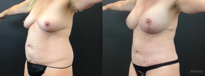 Before & After Mommy Makeover Case 401 Left Oblique View in St. Louis, MO