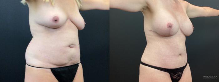 Before & After Mommy Makeover Case 401 Right Oblique View in St. Louis, MO