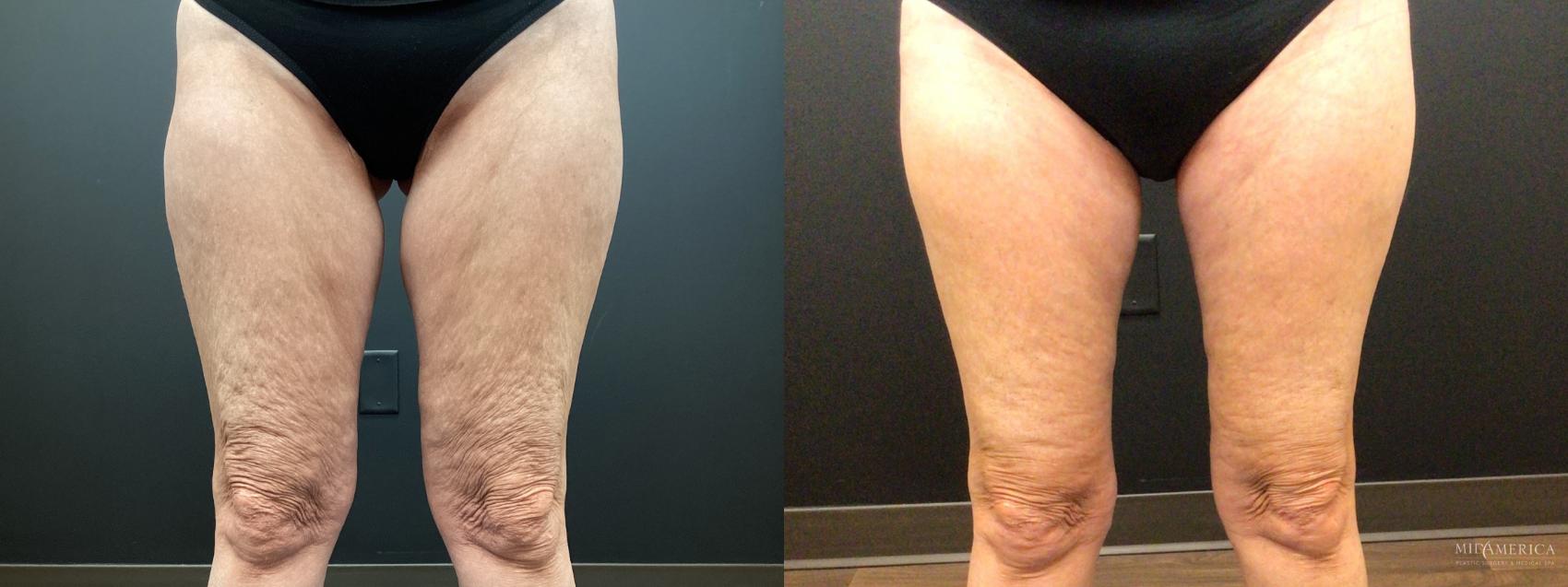 Before & After Thigh Lift Case 400 Front View in St. Louis, MO