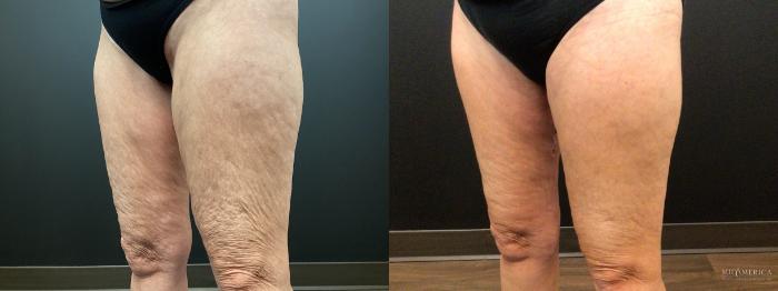 Before & After Thigh Lift Case 400 Left Oblique View in St. Louis, MO