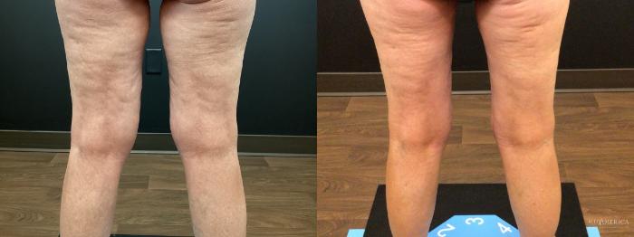 Before & After Thigh Lift Case 400 Right Oblique View in St. Louis, MO