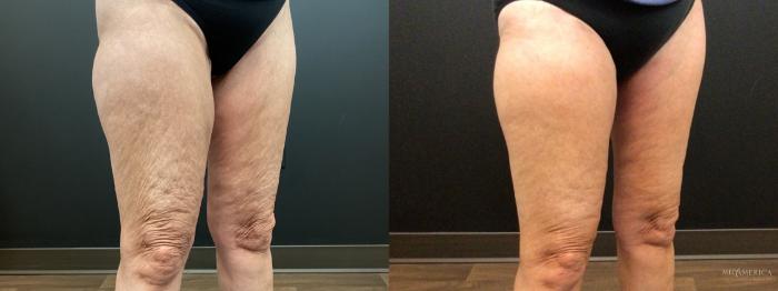 Before & After Thigh Lift Case 400 Right Side View in St. Louis, MO