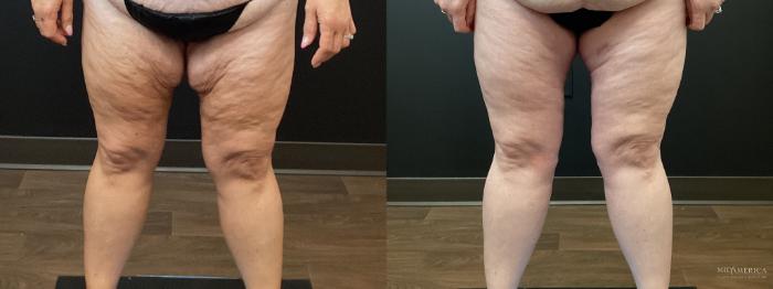 Before & After Thigh Lift Case 402 Front View in St. Louis, MO