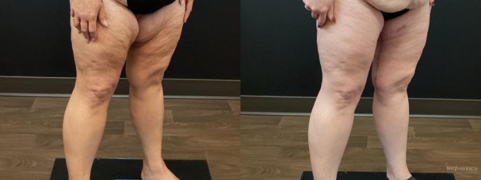 Before & After Thigh Lift Case 402 Left Oblique View in St. Louis, MO