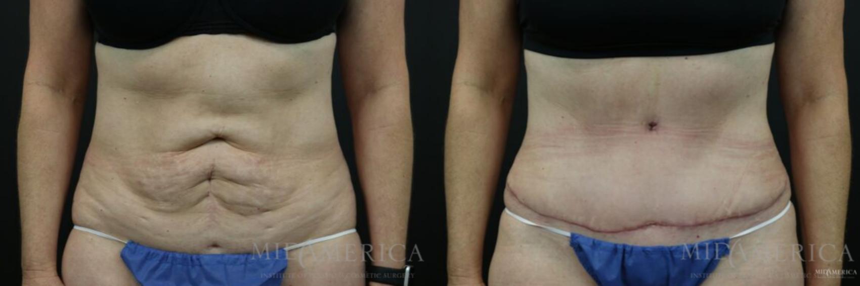 Before & After Tummy Tuck Case 131 View #1 View in St. Louis, MO