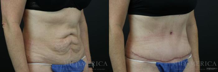 Before & After Tummy Tuck Case 131 View #4 View in St. Louis, MO