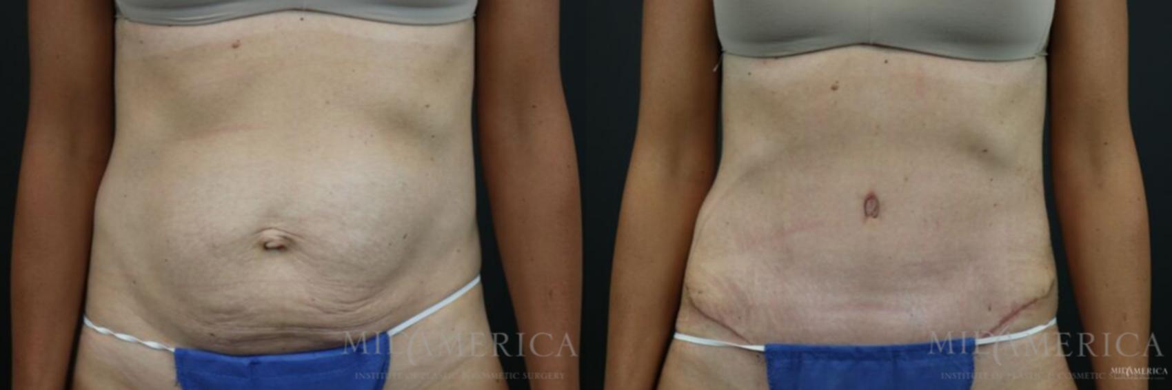 Before & After Tummy Tuck Case 133 View #1 View in Glen Carbon, IL