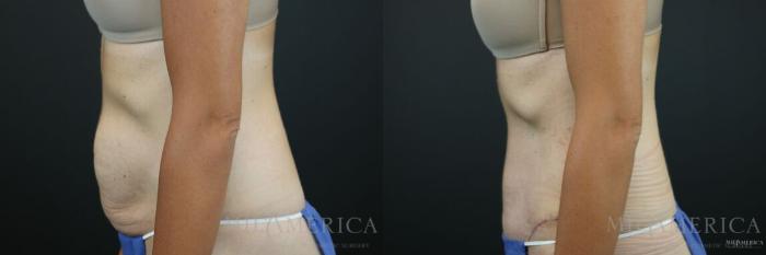Tummy Tuck Before and After Pictures Case 73, Glen Carbon, IL