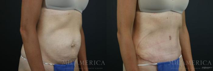Before & After Tummy Tuck Case 133 View #5 View in St. Louis, MO