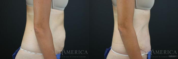 Before & After Tummy Tuck Case 133 View #6 View in St. Louis, MO