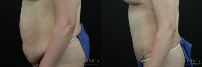 Before & After Tummy Tuck Case 149 View #3 View in St. Louis, MO