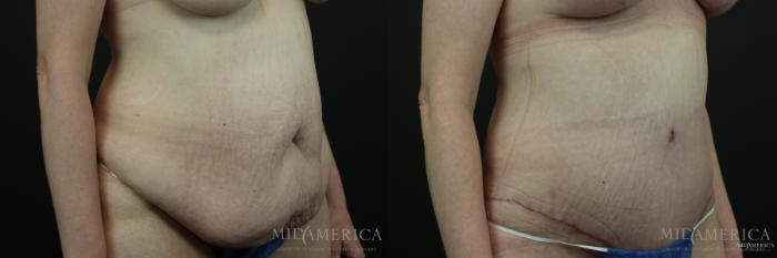 Before & After Tummy Tuck Case 149 View #4 View in St. Louis, MO