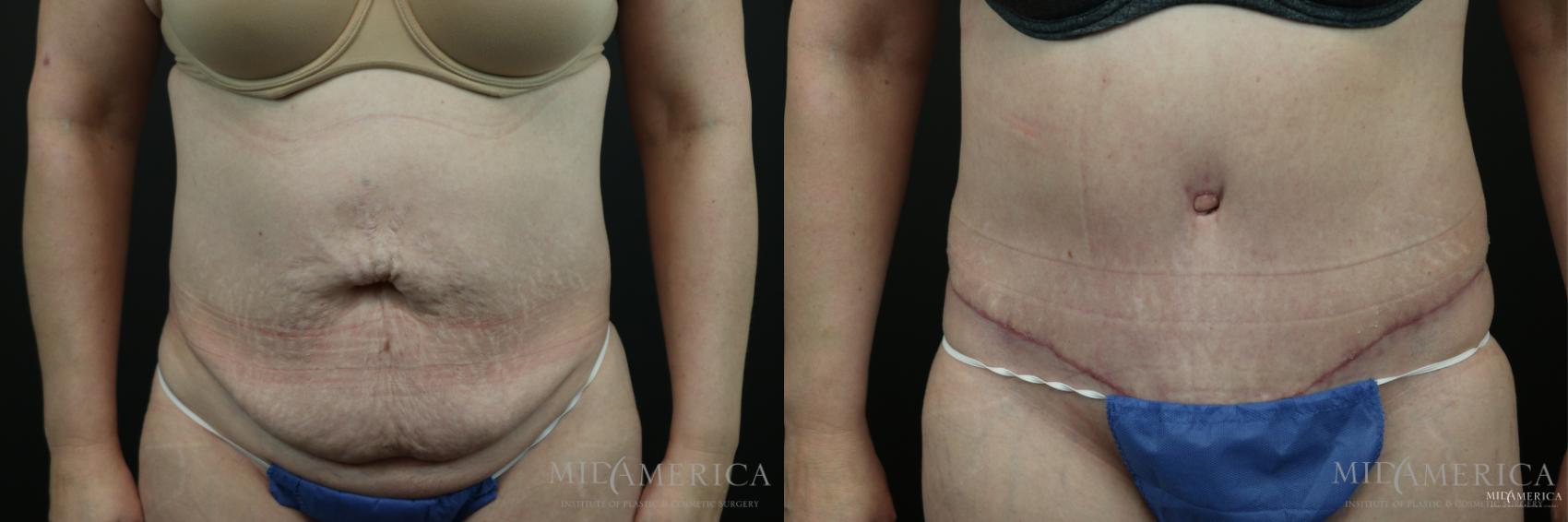 Before & After Tummy Tuck Case 150 View #1 View in Glen Carbon, IL