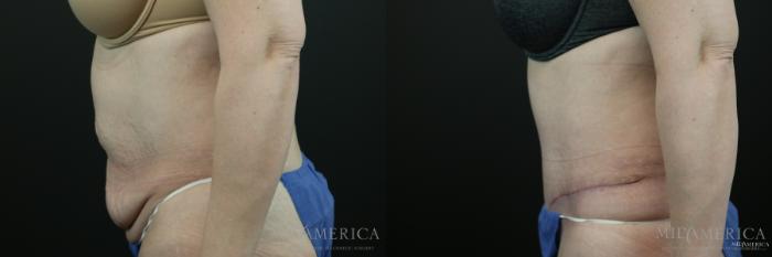 Before & After Tummy Tuck Case 150 View #3 View in St. Louis, MO