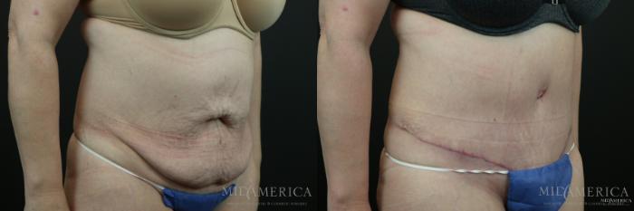 Before & After Tummy Tuck Case 150 View #4 View in St. Louis, MO