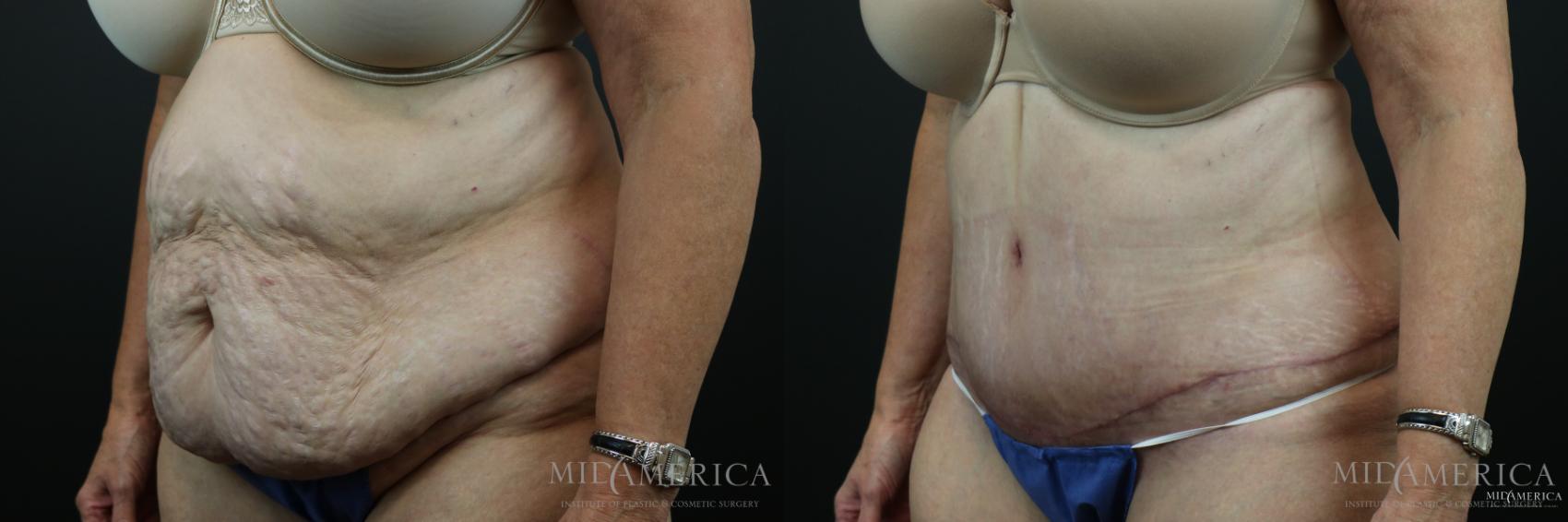 Before & After Tummy Tuck Case 151 View #2 View in Glen Carbon, IL