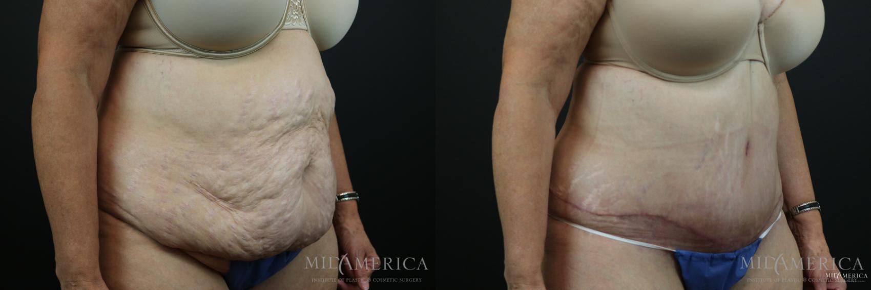 Before & After Tummy Tuck Case 151 View #4 View in Glen Carbon, IL