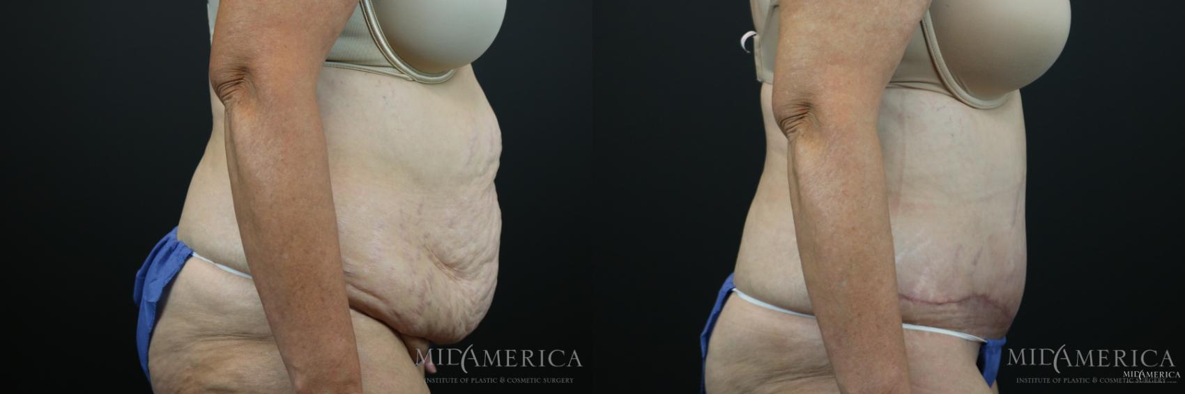 Before & After Tummy Tuck Case 151 View #5 View in Glen Carbon, IL