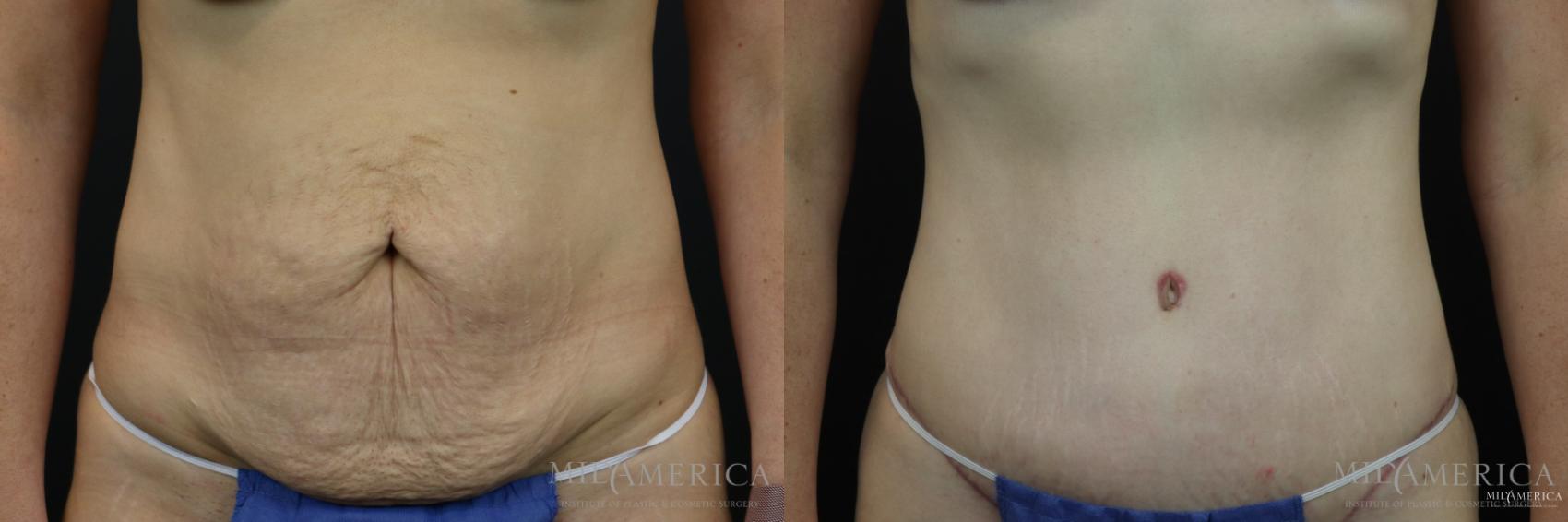 Before & After Tummy Tuck Case 161 View #1 View in Glen Carbon, IL