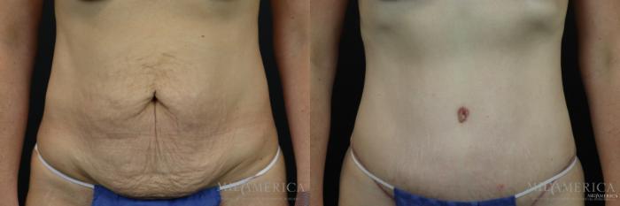 Before & After Tummy Tuck Case 161 View #1 View in St. Louis, MO