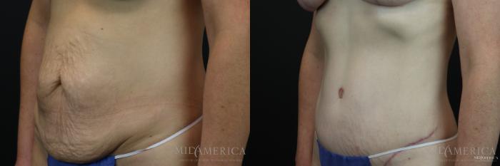 Before & After Tummy Tuck Case 161 View #2 View in St. Louis, MO