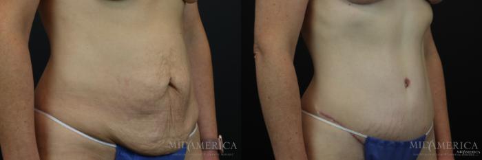 Before & After Tummy Tuck Case 161 View #4 View in St. Louis, MO