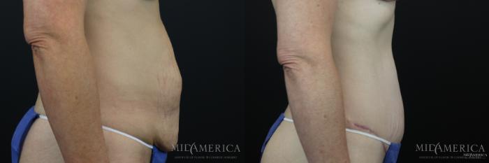 Before & After Tummy Tuck Case 161 View #5 View in St. Louis, MO