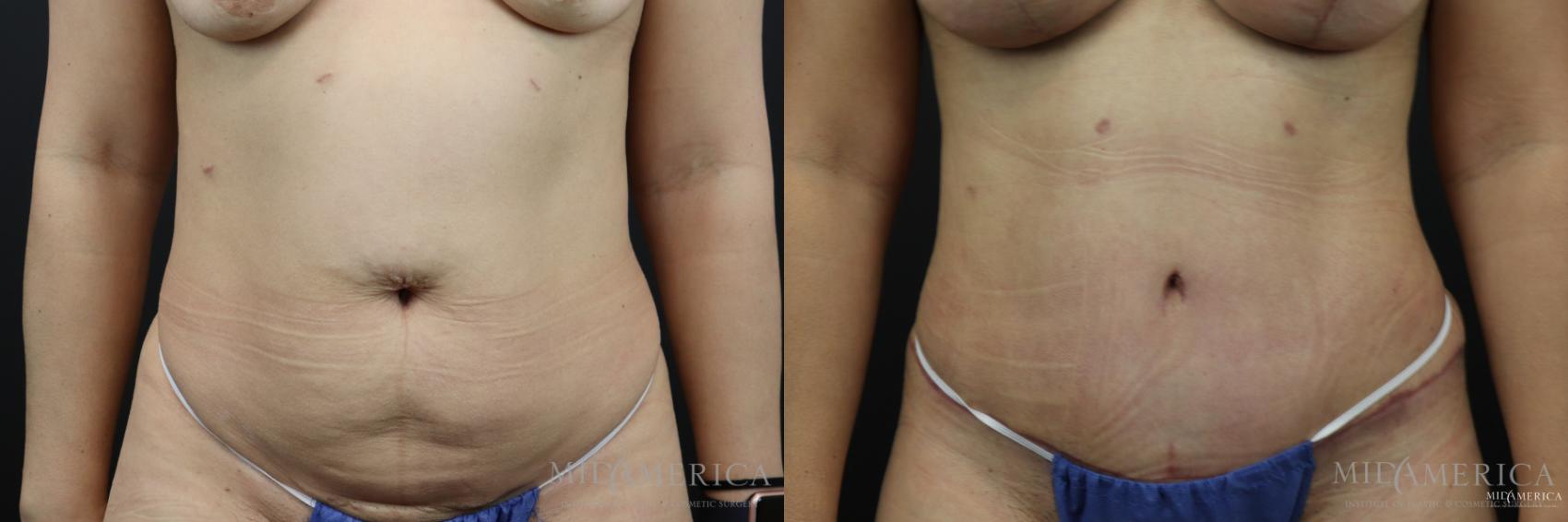 Before & After Tummy Tuck Case 169 View #1 View in Glen Carbon, IL